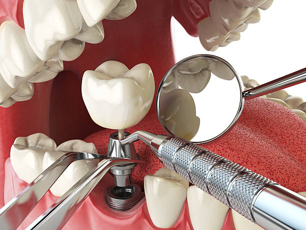 Best Emergency Treatment for Dental Infections or Abscesses in Chino, CA